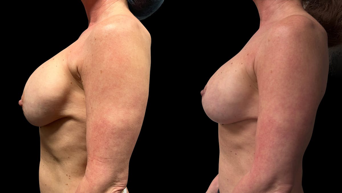 Breast Implant Exchange Before & After Gallery - Patient 259491 - Image 5
