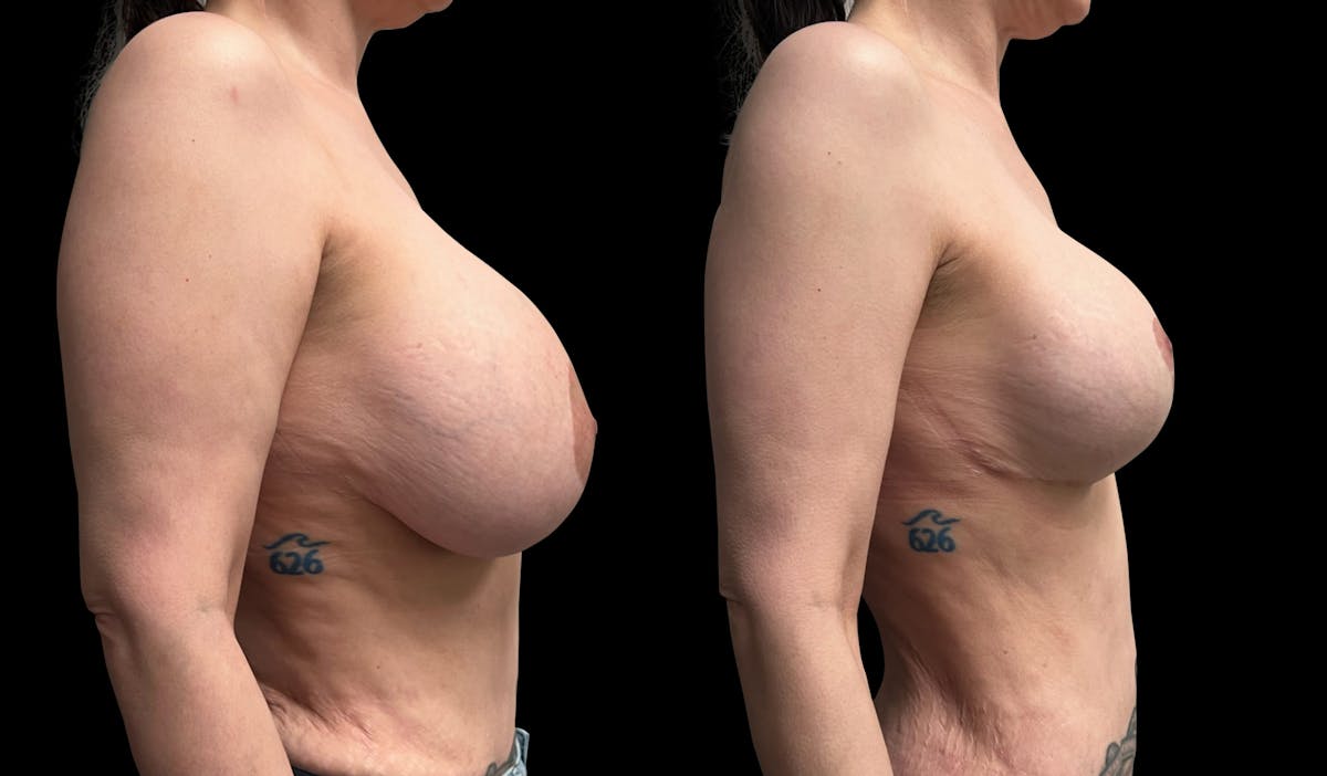 Breast Implant Exchange Before & After Gallery - Patient 808465 - Image 3