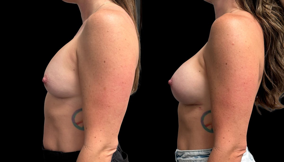 Breast Implant Exchange Before & After Gallery - Patient 247340 - Image 5