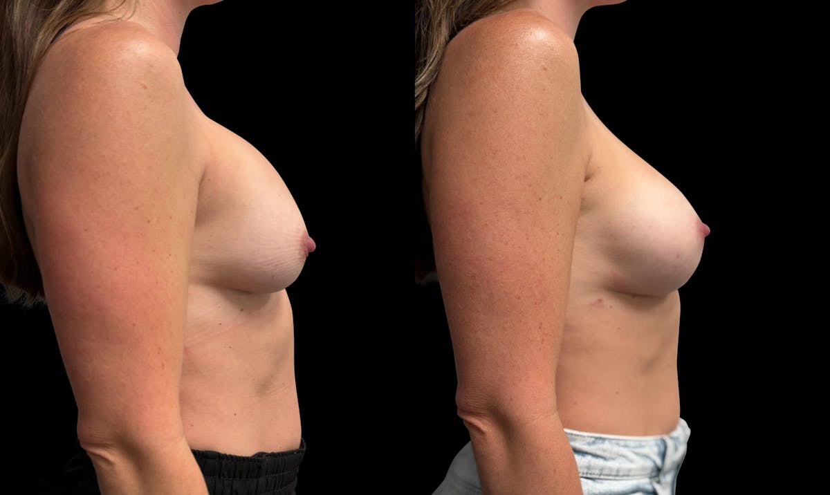 Breast Implant Exchange Before & After Gallery - Patient 247340 - Image 3