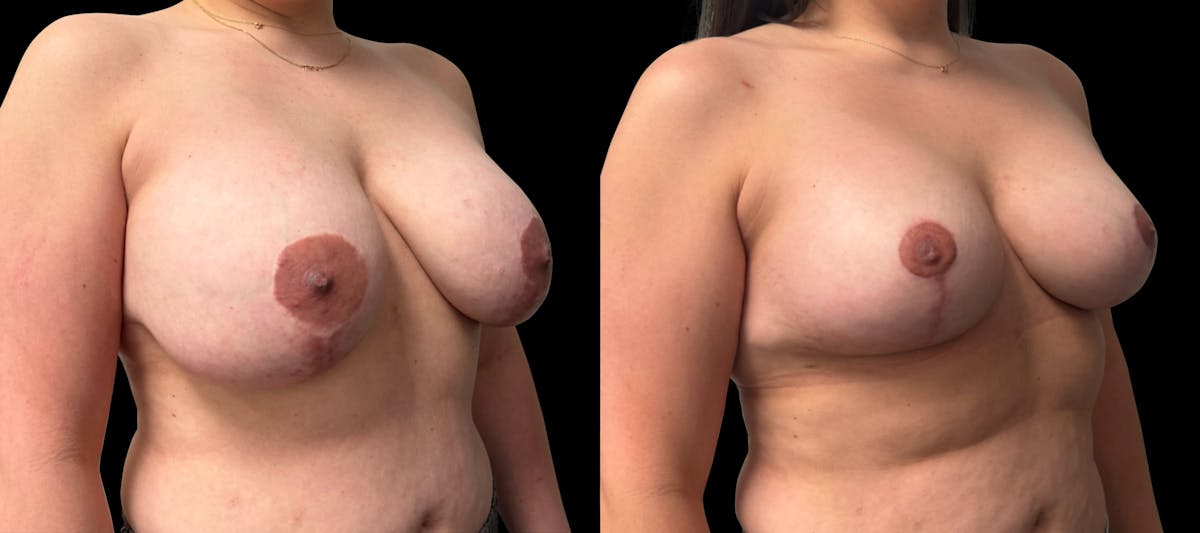 Breast Implant Exchange Before & After Gallery - Patient 697603 - Image 3
