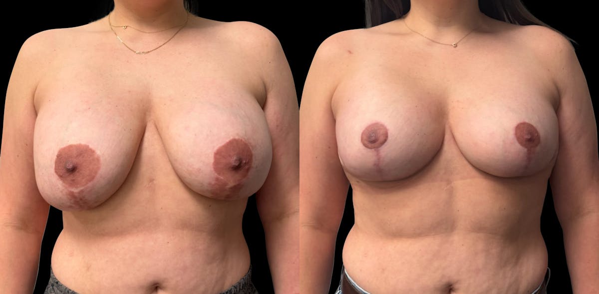Breast Implant Exchange Before & After Gallery - Patient 697603 - Image 1