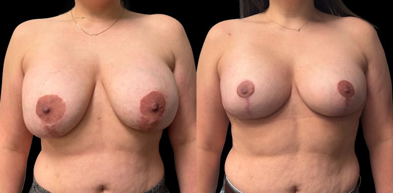 Breast Implant Exchange Before & After Gallery - Patient 697603 - Image 1