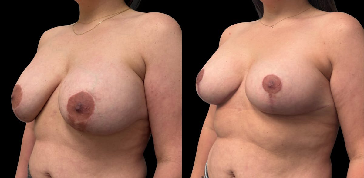 Breast Implant Exchange Before & After Gallery - Patient 697603 - Image 5