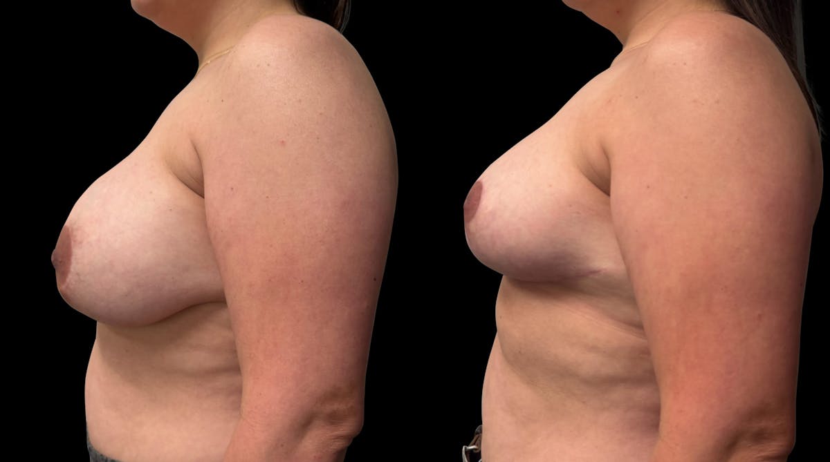 Breast Implant Exchange Before & After Gallery - Patient 697603 - Image 6