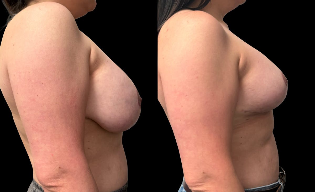 Breast Implant Exchange Before & After Gallery - Patient 697603 - Image 4