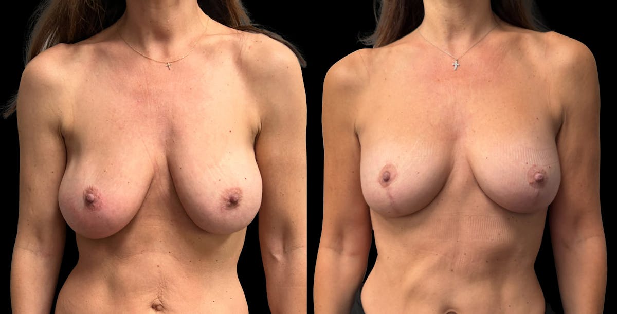 Breast Implant Exchange Before & After Gallery - Patient 399448 - Image 1