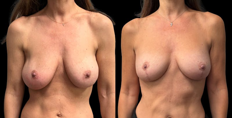 Breast Implant Exchange Before & After Gallery - Patient 399448 - Image 1
