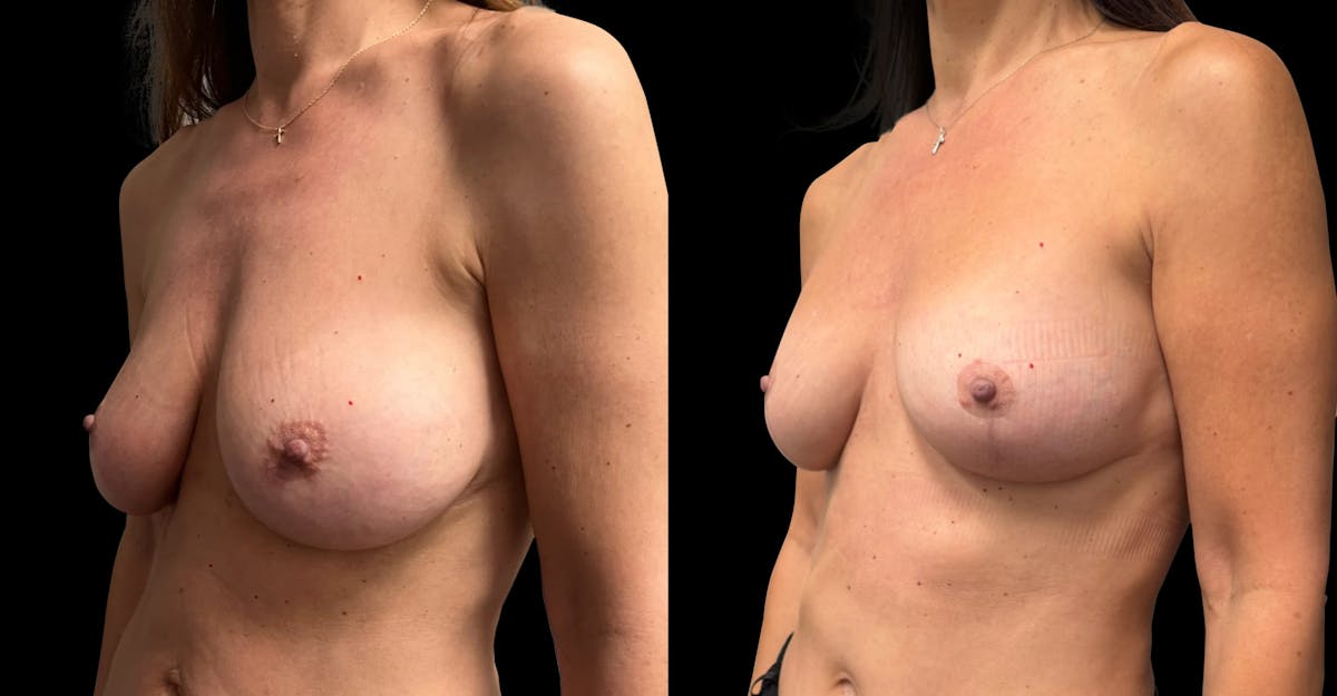 Breast Implant Exchange Before & After Gallery - Patient 399448 - Image 4