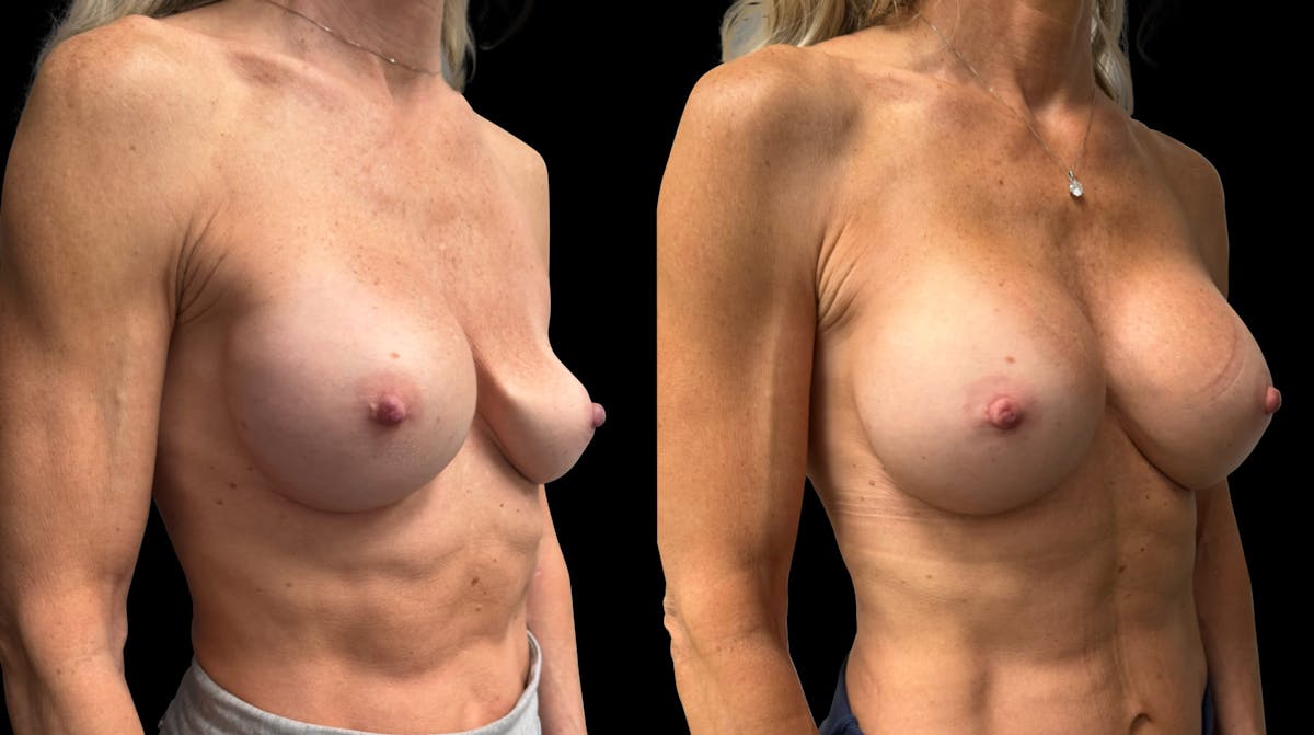 Breast Implant Exchange Before & After Gallery - Patient 118374 - Image 2