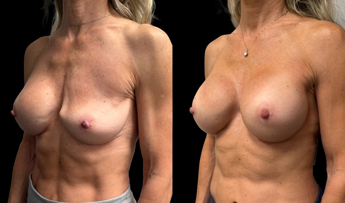 Breast Implant Exchange Before & After Gallery - Patient 118374 - Image 3