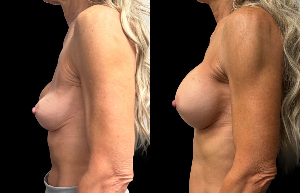 Breast Implant Exchange Before & After Gallery - Patient 118374 - Image 4