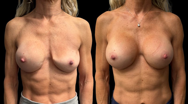 Breast Implant Exchange Before & After Gallery - Patient 118374 - Image 1