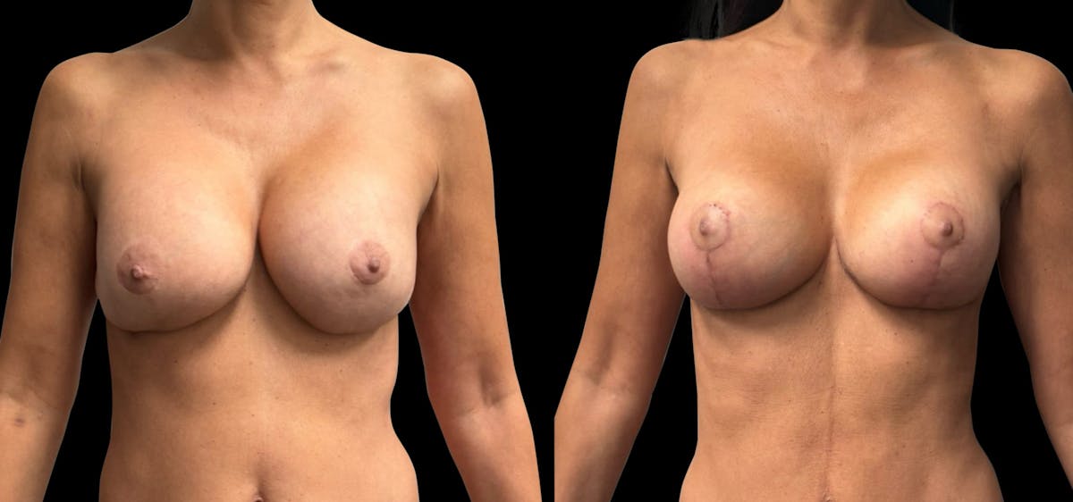 Breast Implant Exchange Before & After Gallery - Patient 187592 - Image 1
