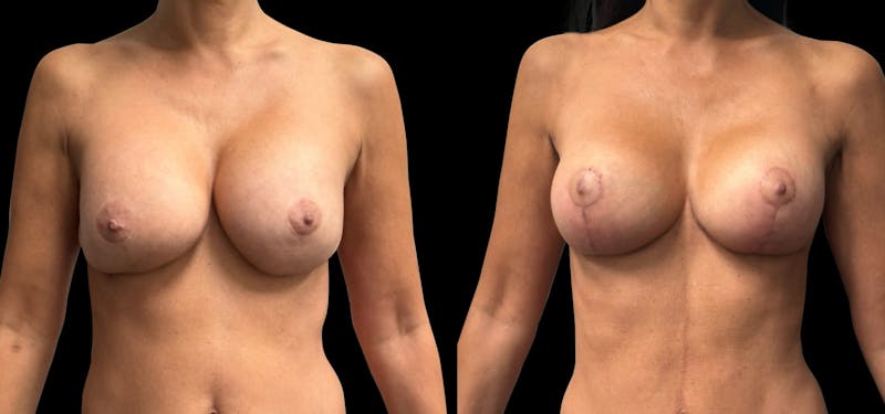 Breast Implant Exchange Before & After Gallery - Patient 187592 - Image 1