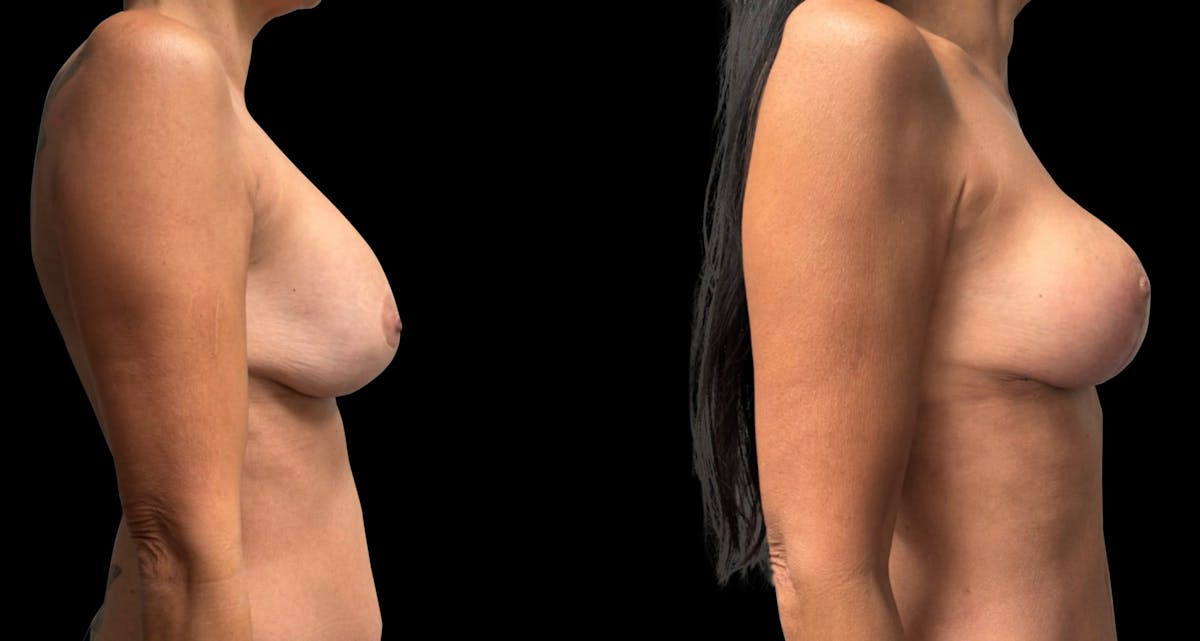 Breast Implant Exchange Before & After Gallery - Patient 187592 - Image 3