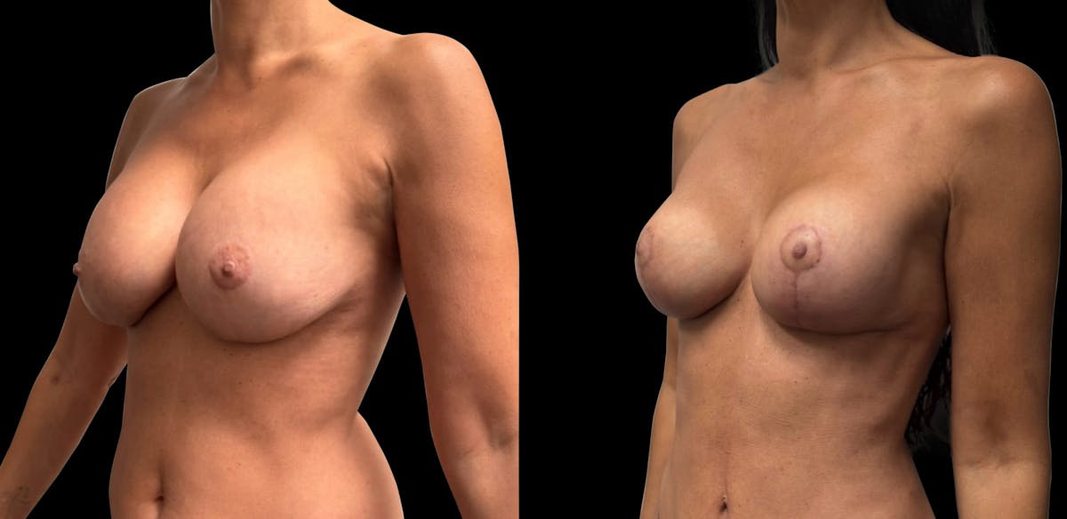 Breast Implant Exchange Before & After Gallery - Patient 187592 - Image 4