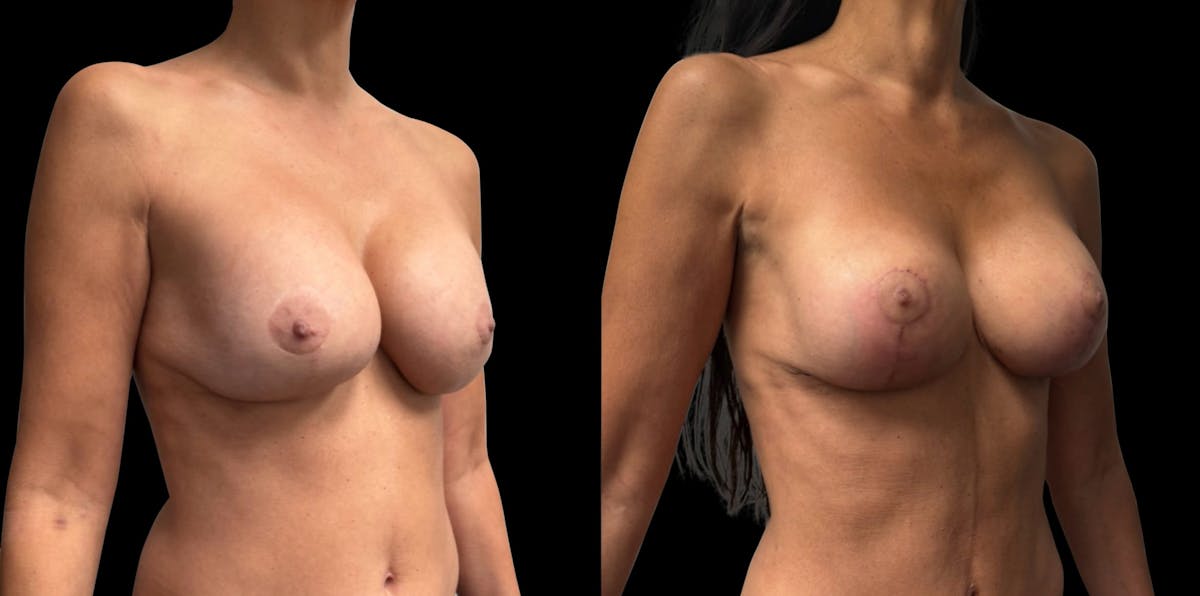 Breast Implant Exchange Before & After Gallery - Patient 187592 - Image 2