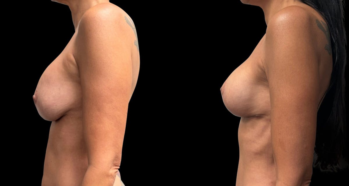 Breast Implant Exchange Before & After Gallery - Patient 187592 - Image 5