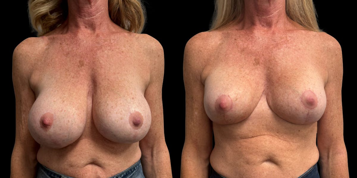Breast Implant Exchange Before & After Gallery - Patient 255114 - Image 1