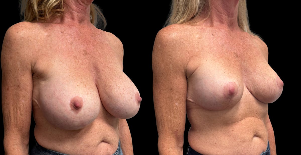 Breast Implant Exchange Before & After Gallery - Patient 255114 - Image 2
