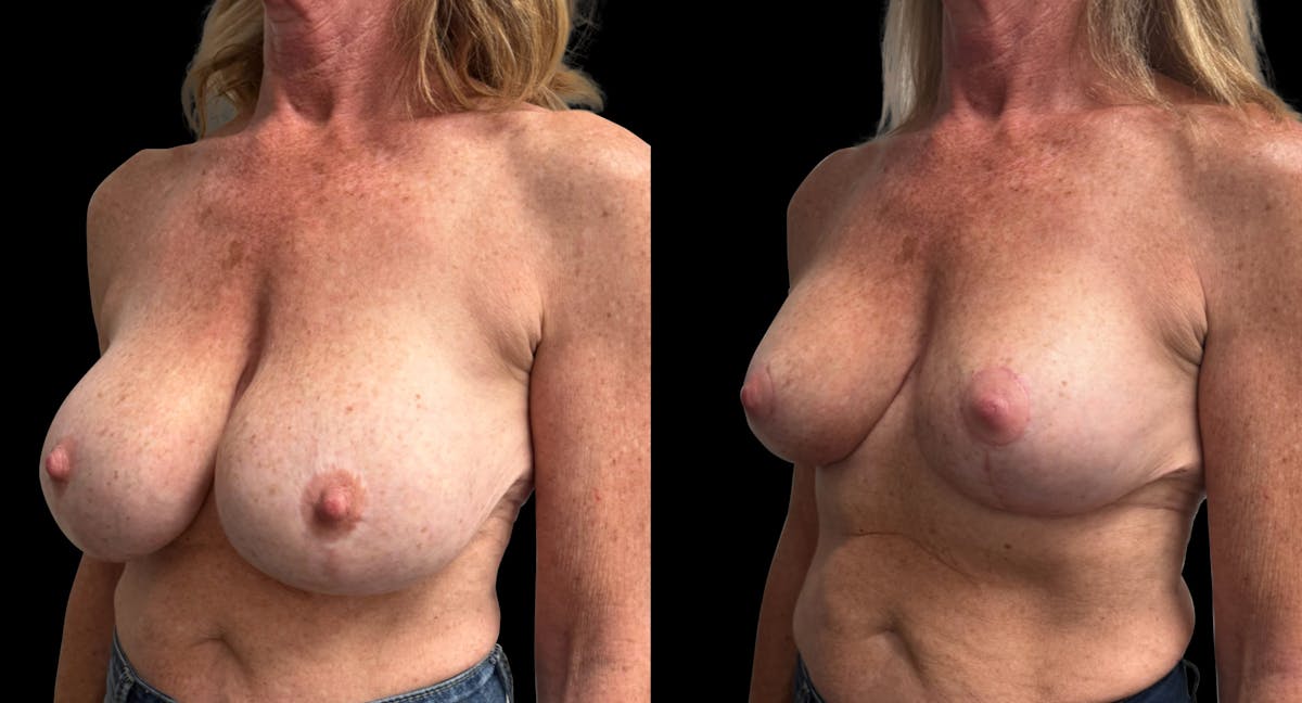 Breast Implant Exchange Before & After Gallery - Patient 255114 - Image 3