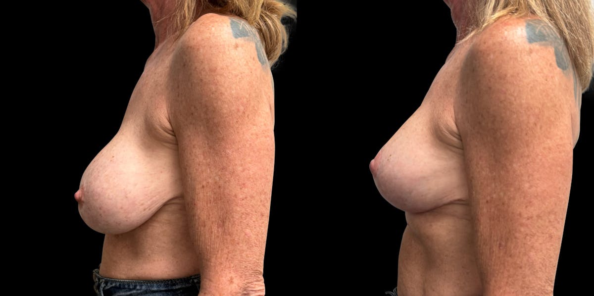 Breast Implant Exchange Before & After Gallery - Patient 255114 - Image 4