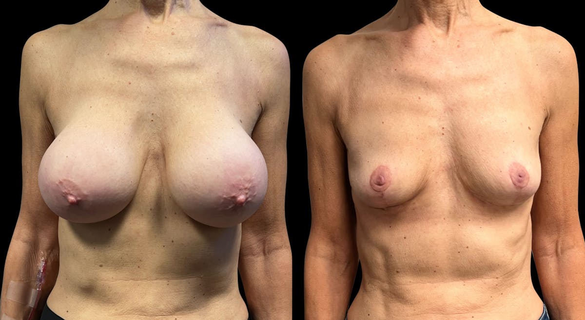 Breast Implant Removal with Lift Before & After Gallery - Patient 297282 - Image 1