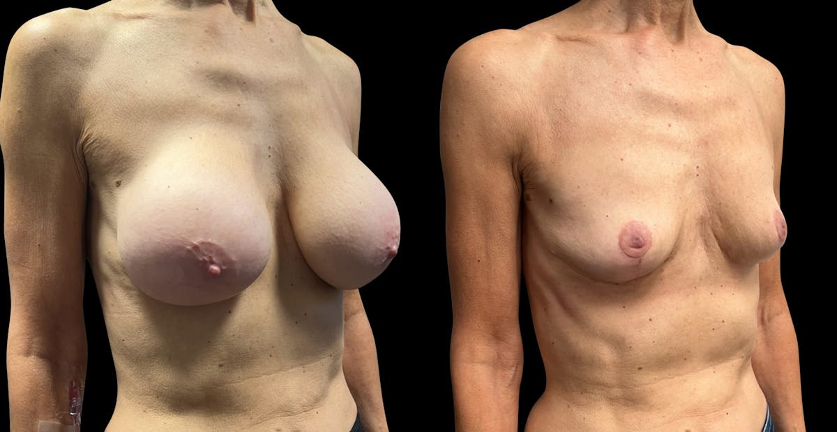 Breast Implant Removal with Lift Before & After Gallery - Patient 297282 - Image 2