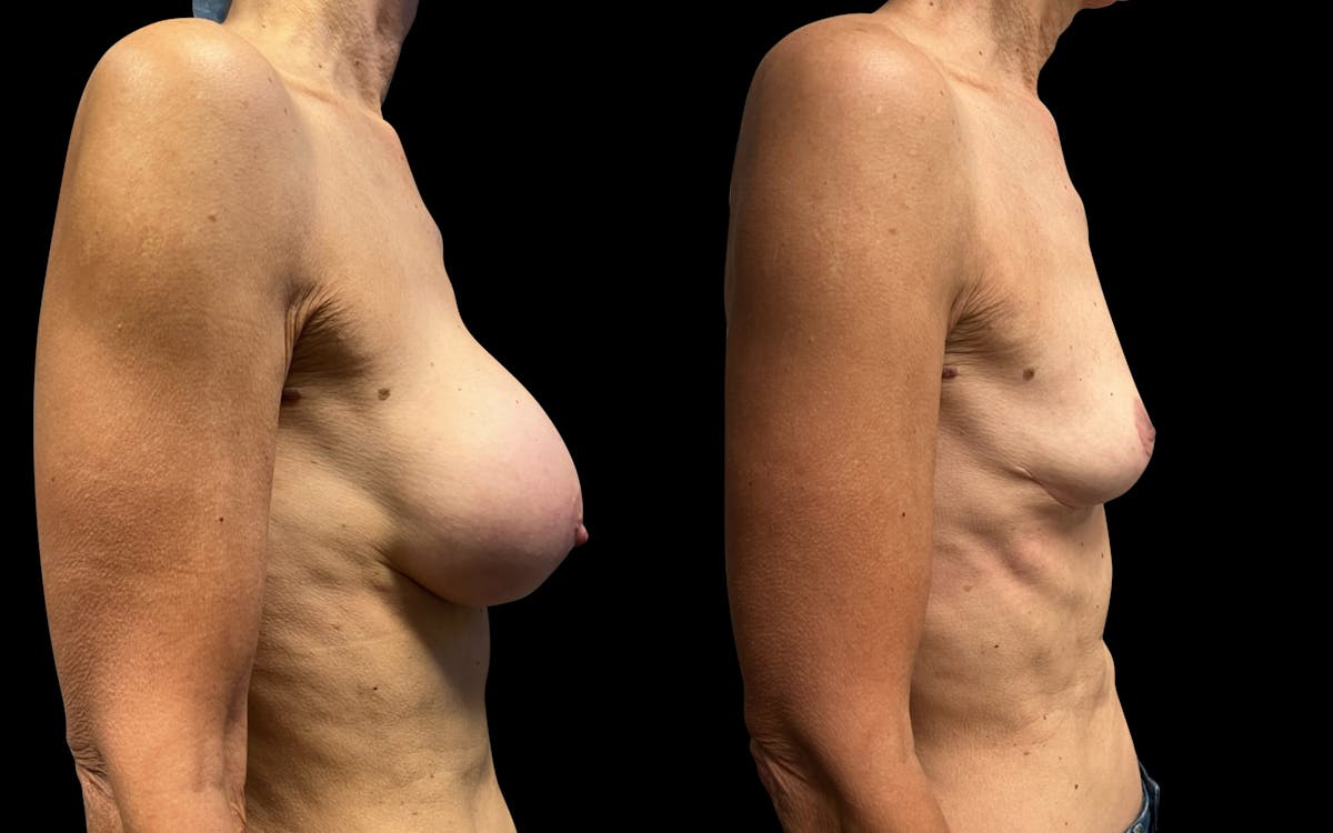 Breast Implant Removal with Lift Before & After Gallery - Patient 297282 - Image 3