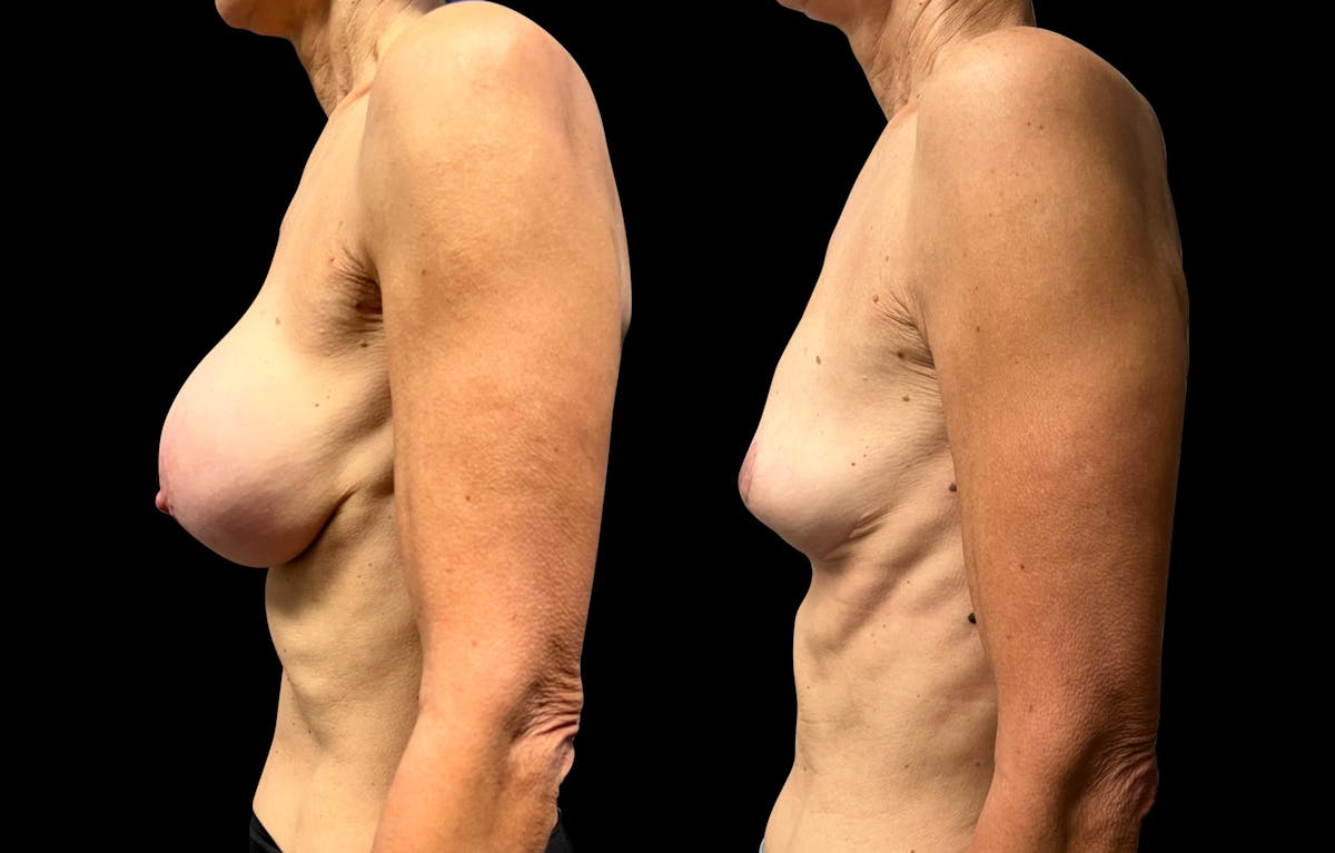 Breast Implant Removal with Lift Before & After Gallery - Patient 297282 - Image 5
