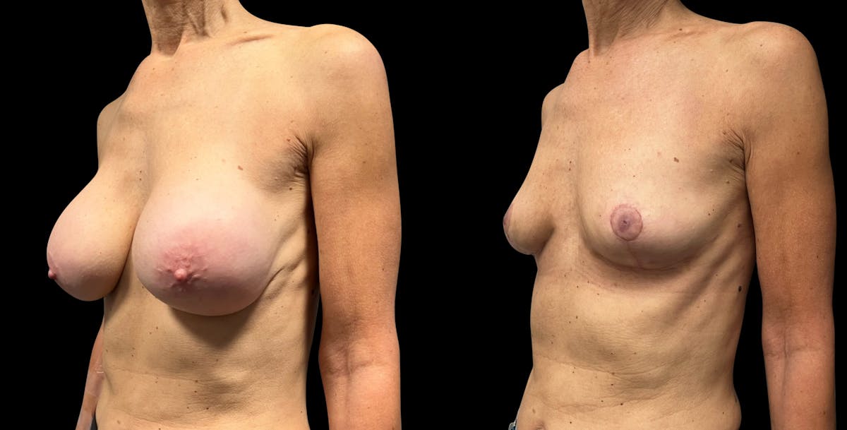 Breast Implant Removal with Lift Before & After Gallery - Patient 297282 - Image 4