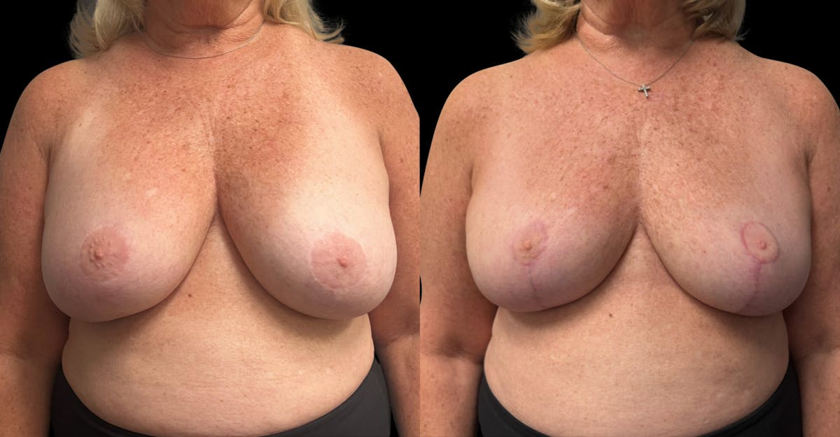 Breast Implant Removal with Lift Before & After Gallery - Patient 289702 - Image 1