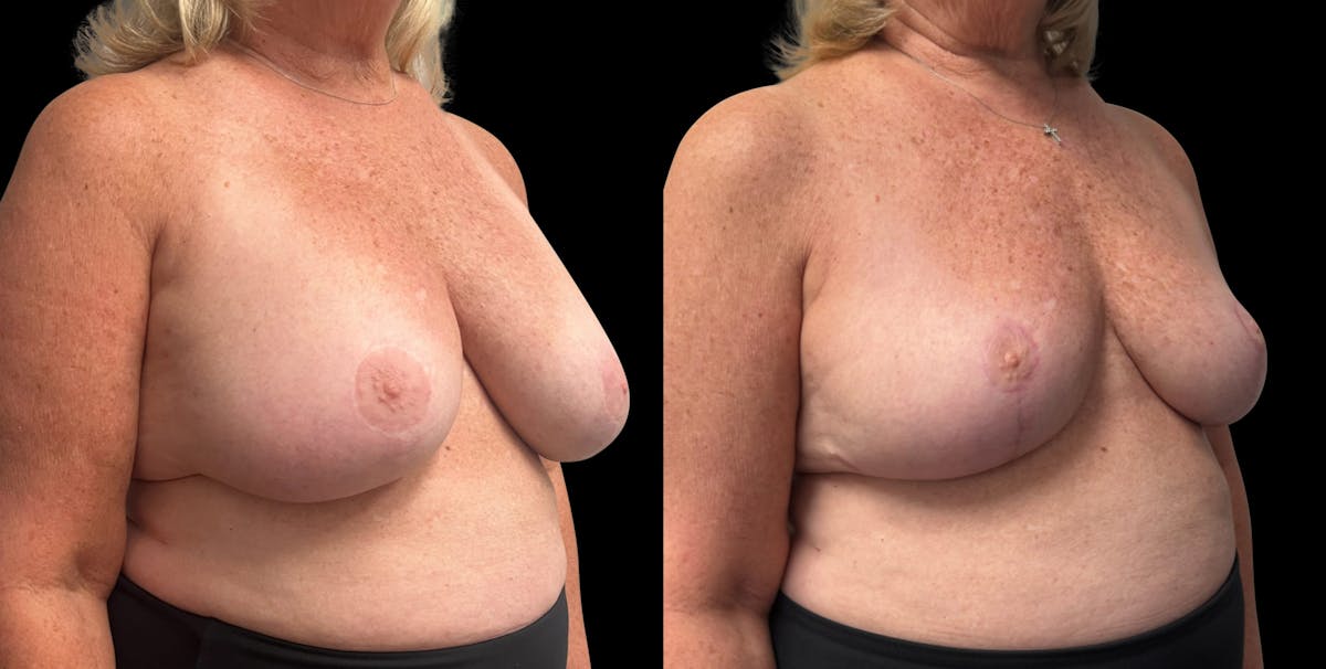 Breast Implant Removal with Lift Before & After Gallery - Patient 289702 - Image 2