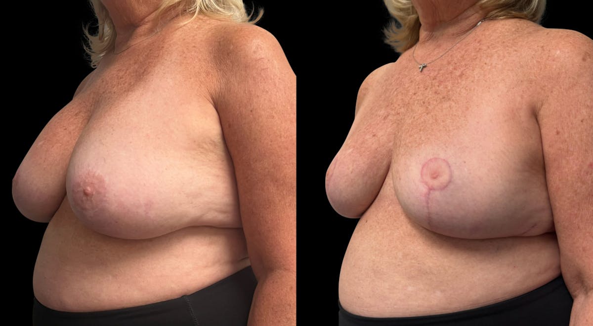 Breast Implant Removal with Lift Before & After Gallery - Patient 289702 - Image 4