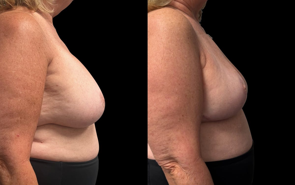 Breast Implant Removal with Lift Before & After Gallery - Patient 289702 - Image 3