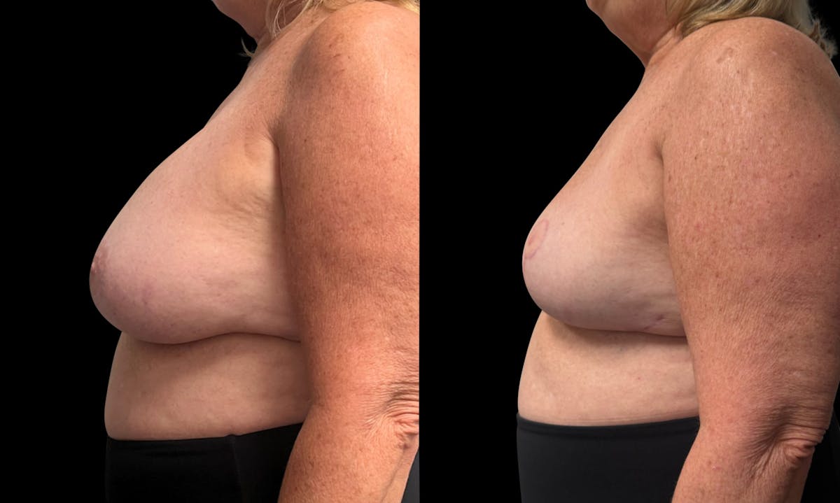 Breast Implant Removal with Lift Before & After Gallery - Patient 289702 - Image 5