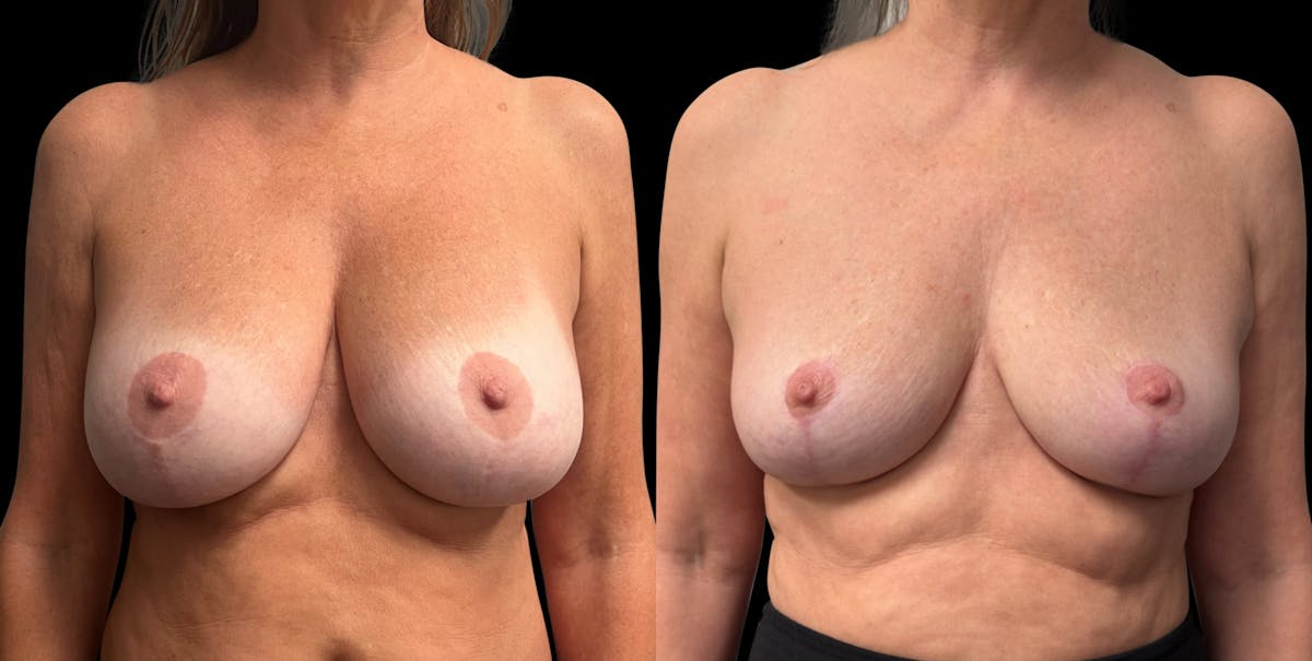 Breast Implant Removal with Lift Before & After Gallery - Patient 136875 - Image 1