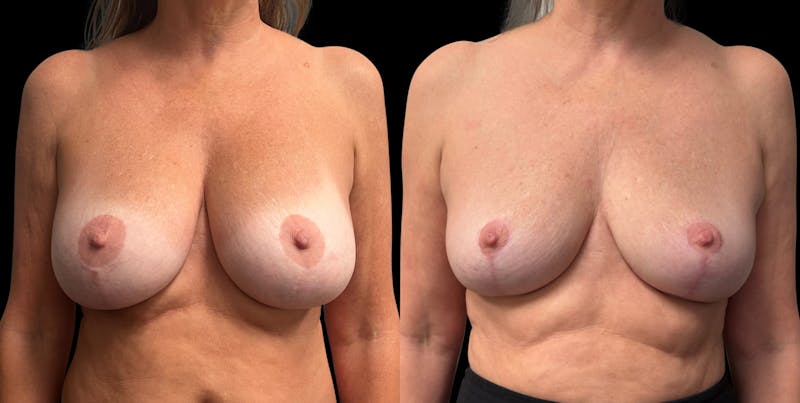 Breast Implant Removal with Lift Before & After Gallery - Patient 136875 - Image 1