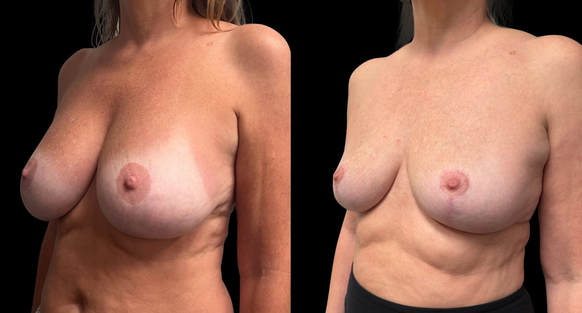 Breast Implant Removal with Lift Before & After Gallery - Patient 136875 - Image 3