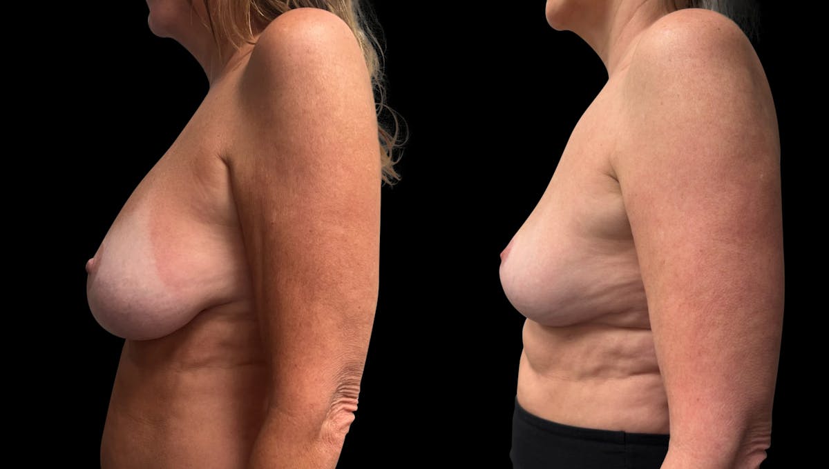 Breast Implant Removal with Lift Before & After Gallery - Patient 136875 - Image 4