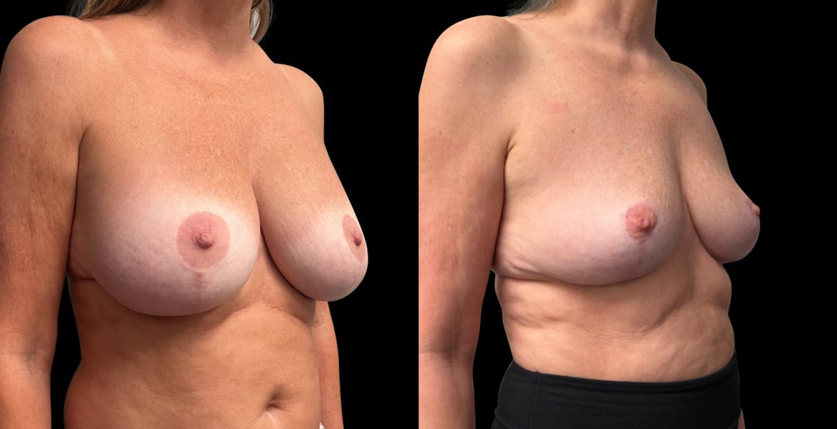 Breast Implant Removal with Lift Before & After Gallery - Patient 136875 - Image 2