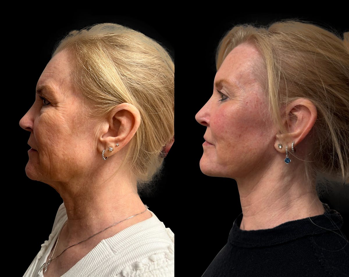 Facelift Before & After Gallery - Patient 198681 - Image 5