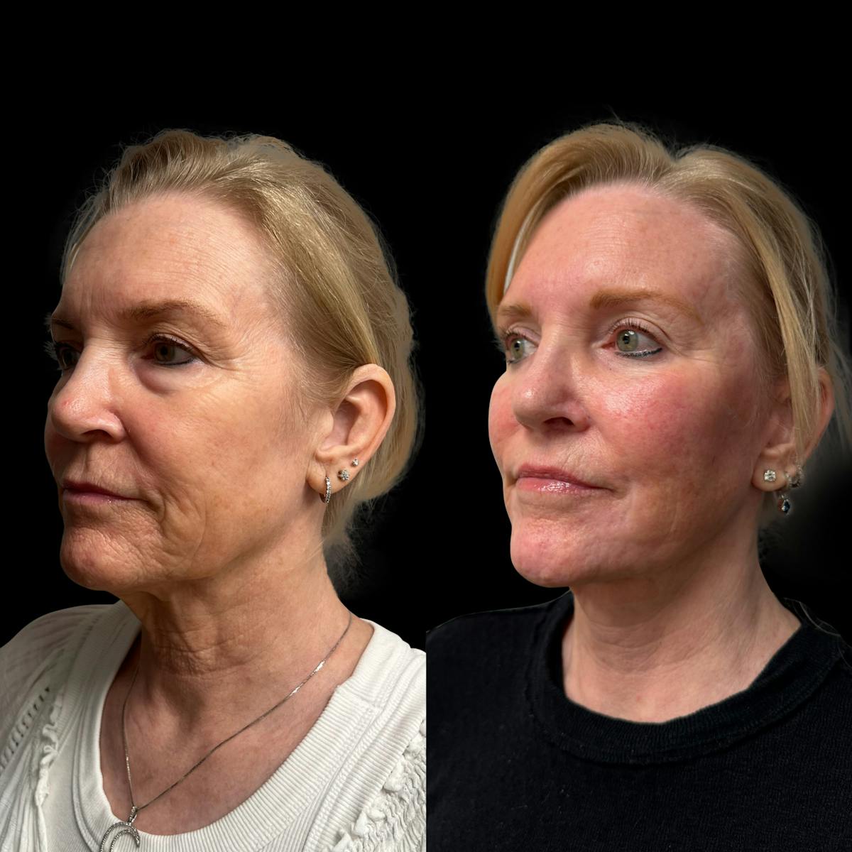 Facelift Before & After Gallery - Patient 198681 - Image 4