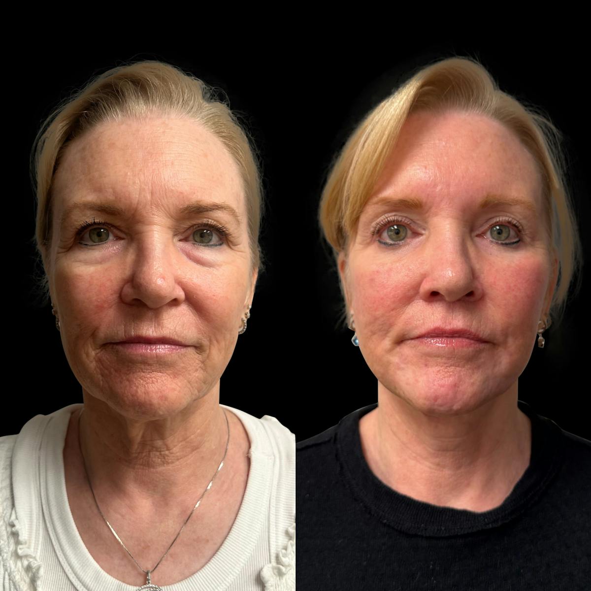Facelift Before & After Gallery - Patient 198681 - Image 1