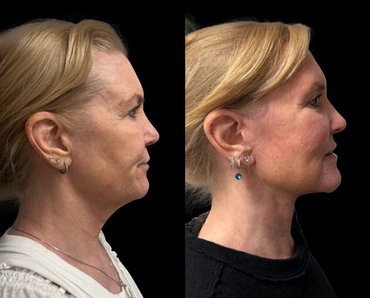 Facelift Before & After Gallery - Patient 198681 - Image 3