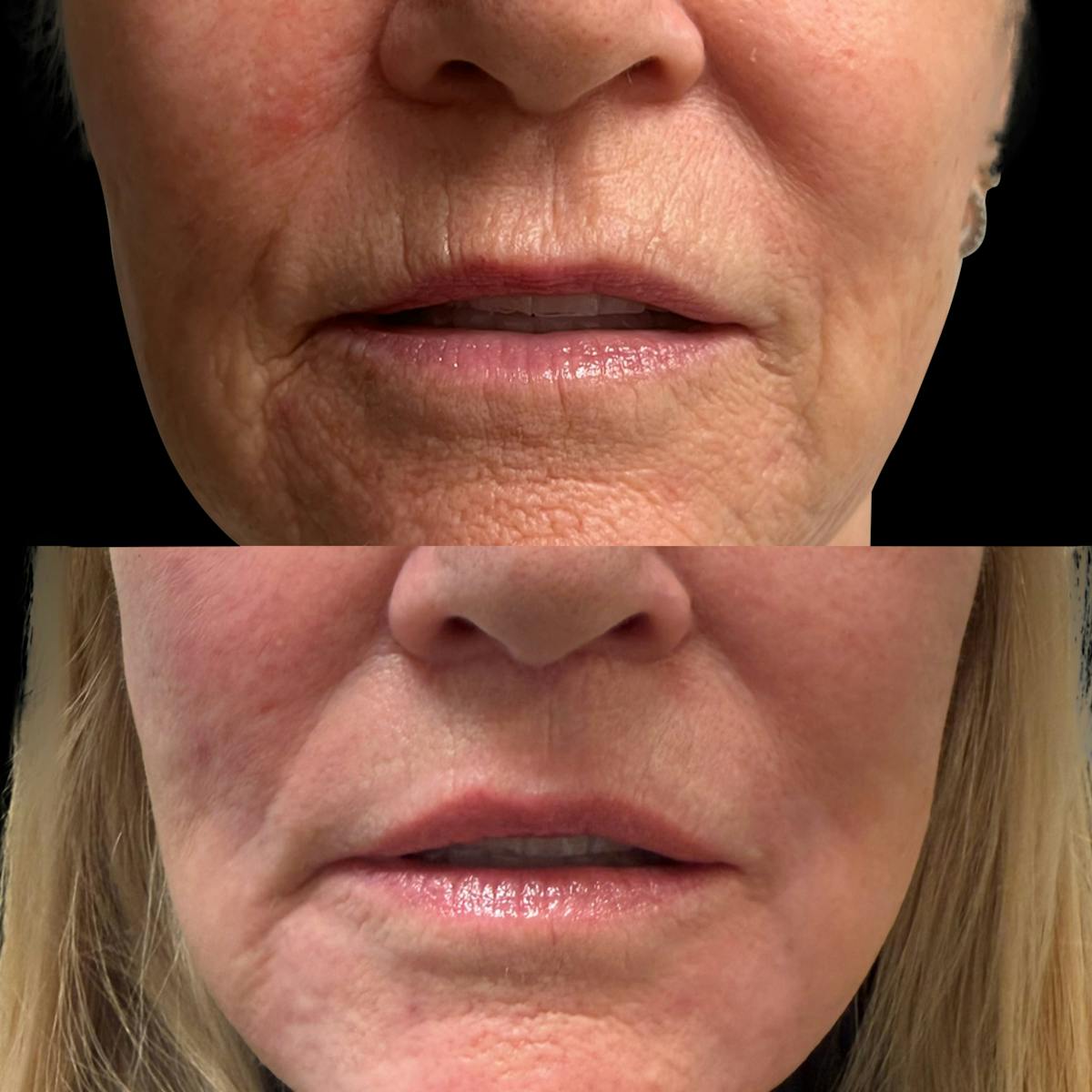 Facelift Before & After Gallery - Patient 198681 - Image 6