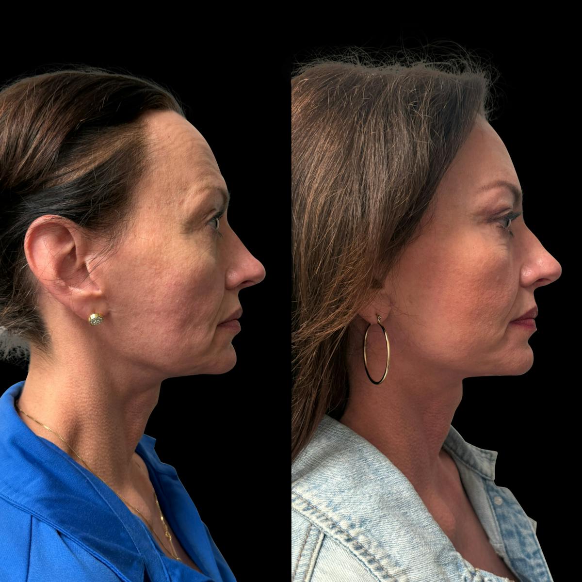 Facelift Before & After Gallery - Patient 496746 - Image 3