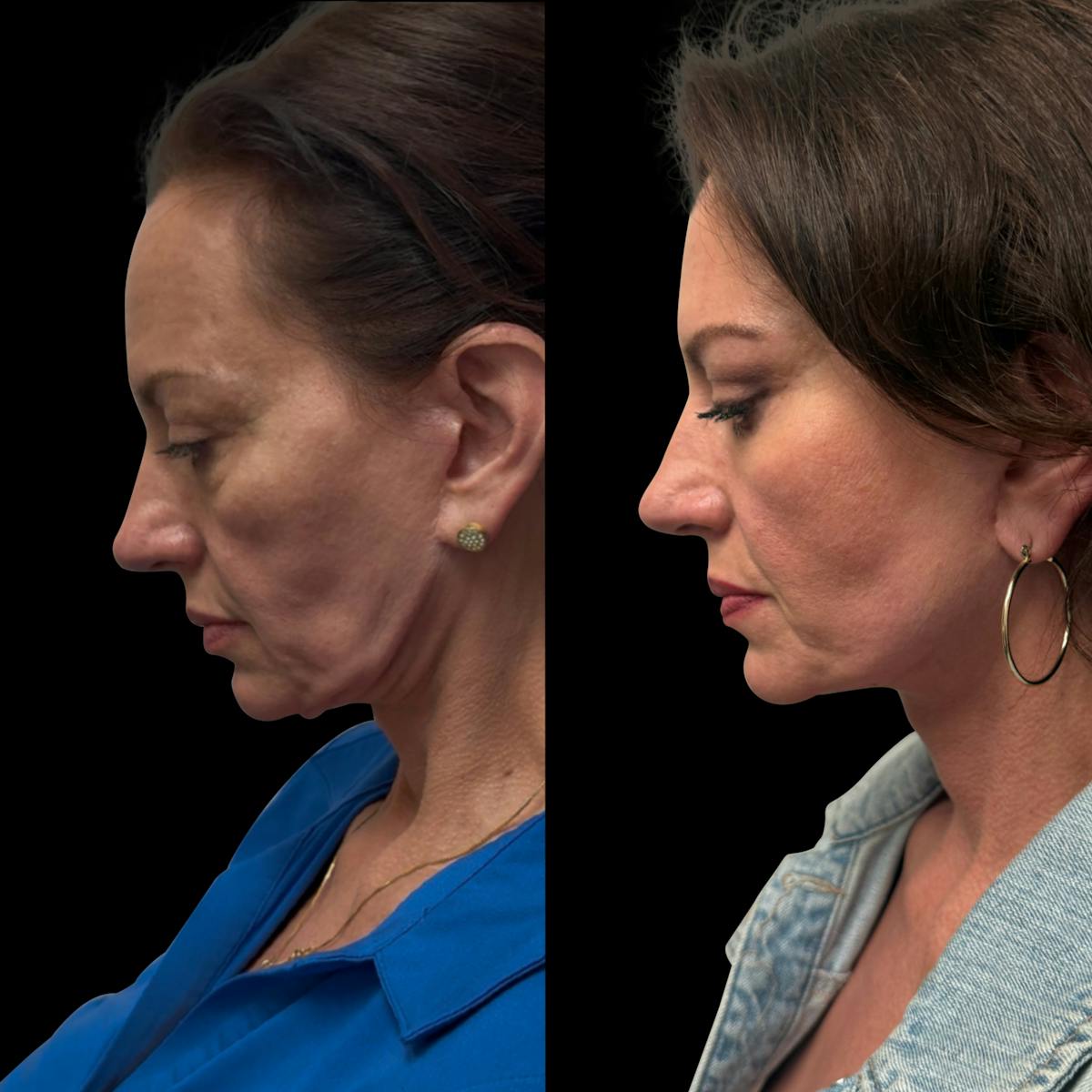 Facelift Before & After Gallery - Patient 496746 - Image 6