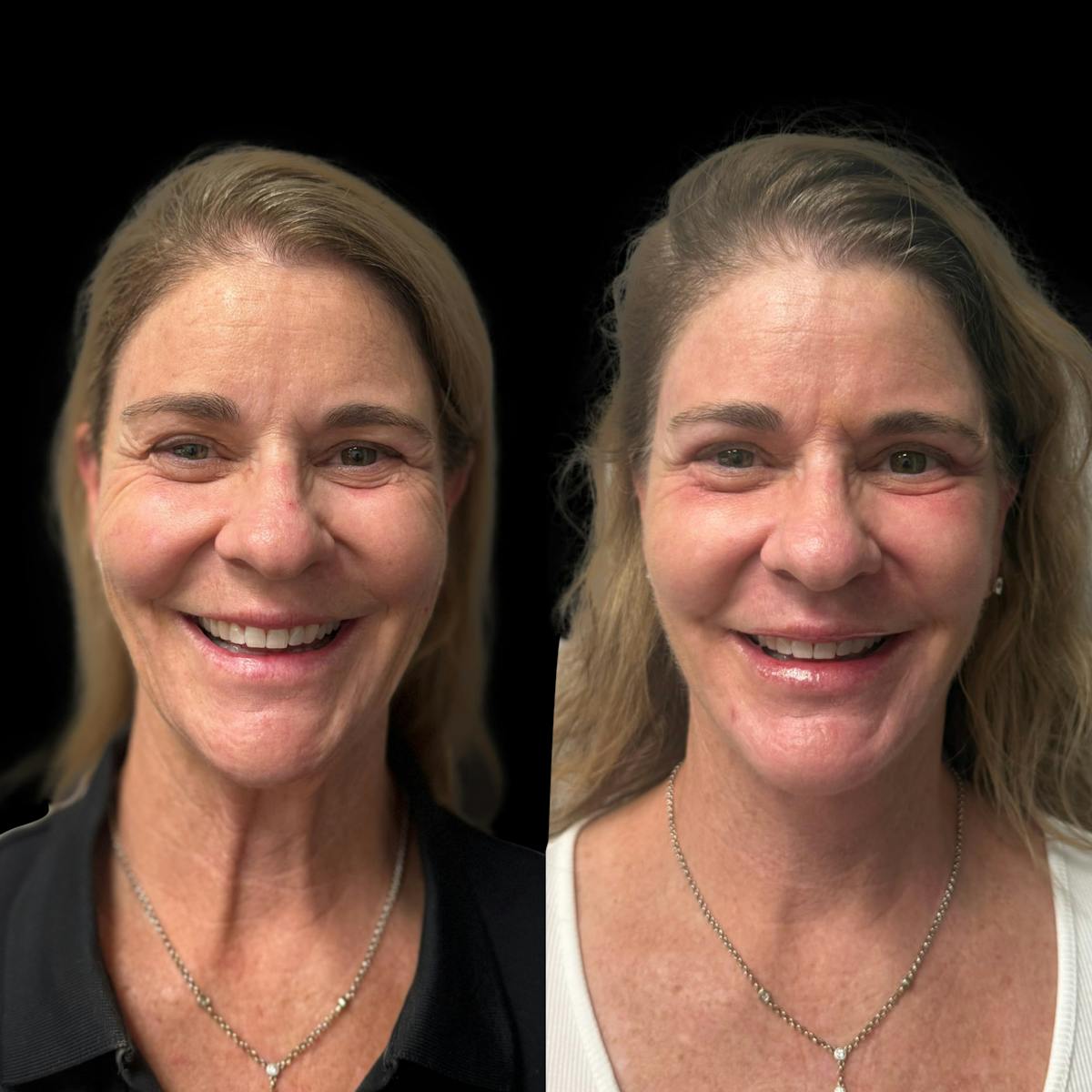 Facelift Before & After Gallery - Patient 103775 - Image 1